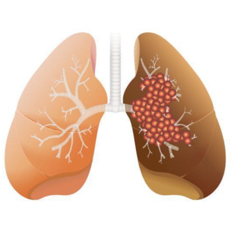 L\'alta dose di NMN inibisce la crescita dell\'adenocarcinoma polmonare